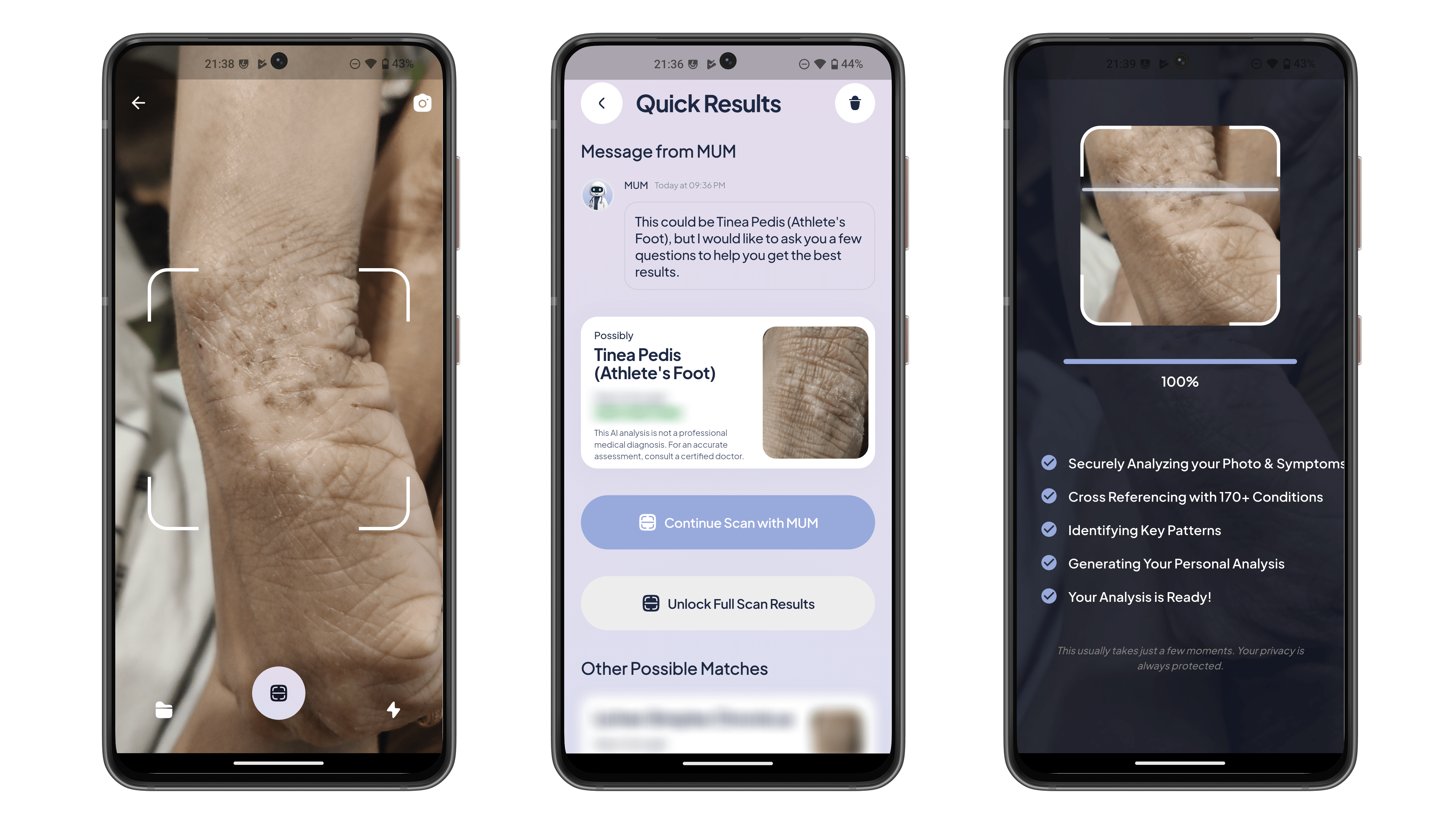 Trois écrans de smartphone affichant une application d'analyse du pied avec des résultats pour Tinea Pedis.